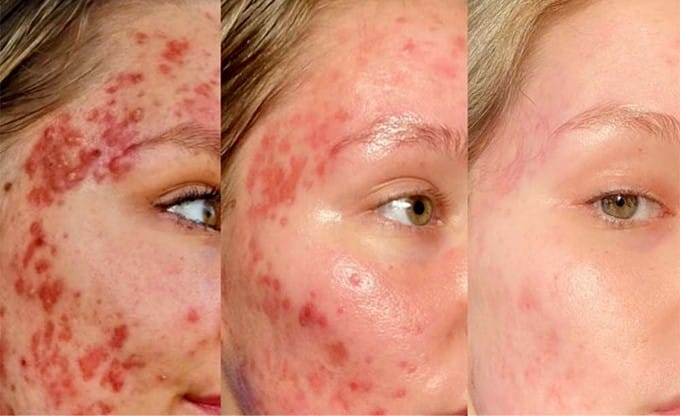 Roaccutane Nedir ve Neden İntihara Sebep Oluyor?